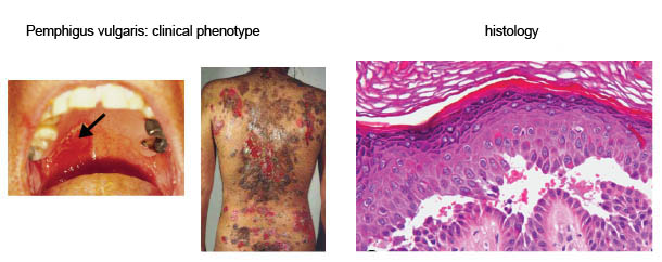 pemphigus