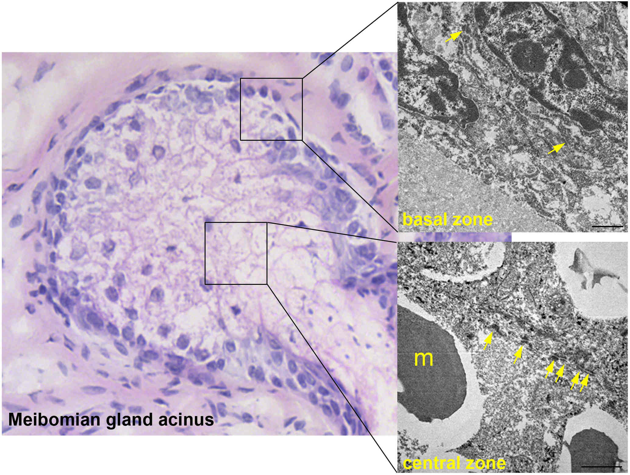 crohn1